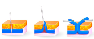 operación de flebectomía